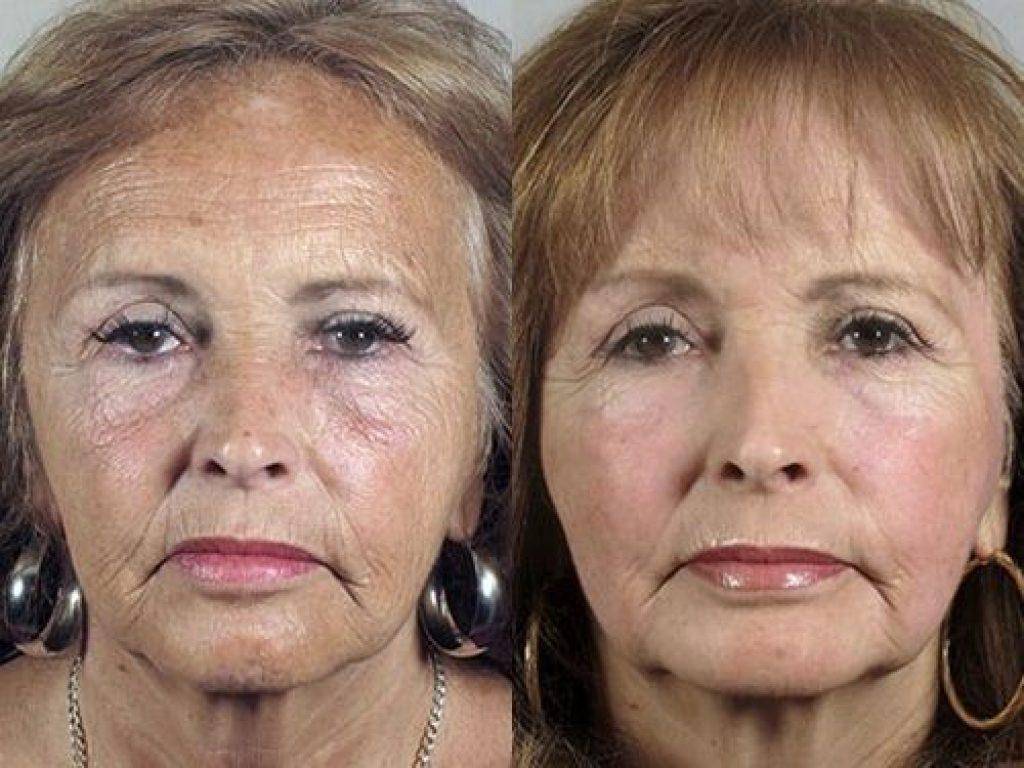 Операции после 70 лет. Омоложение лица до и после. Возрастные морщины.