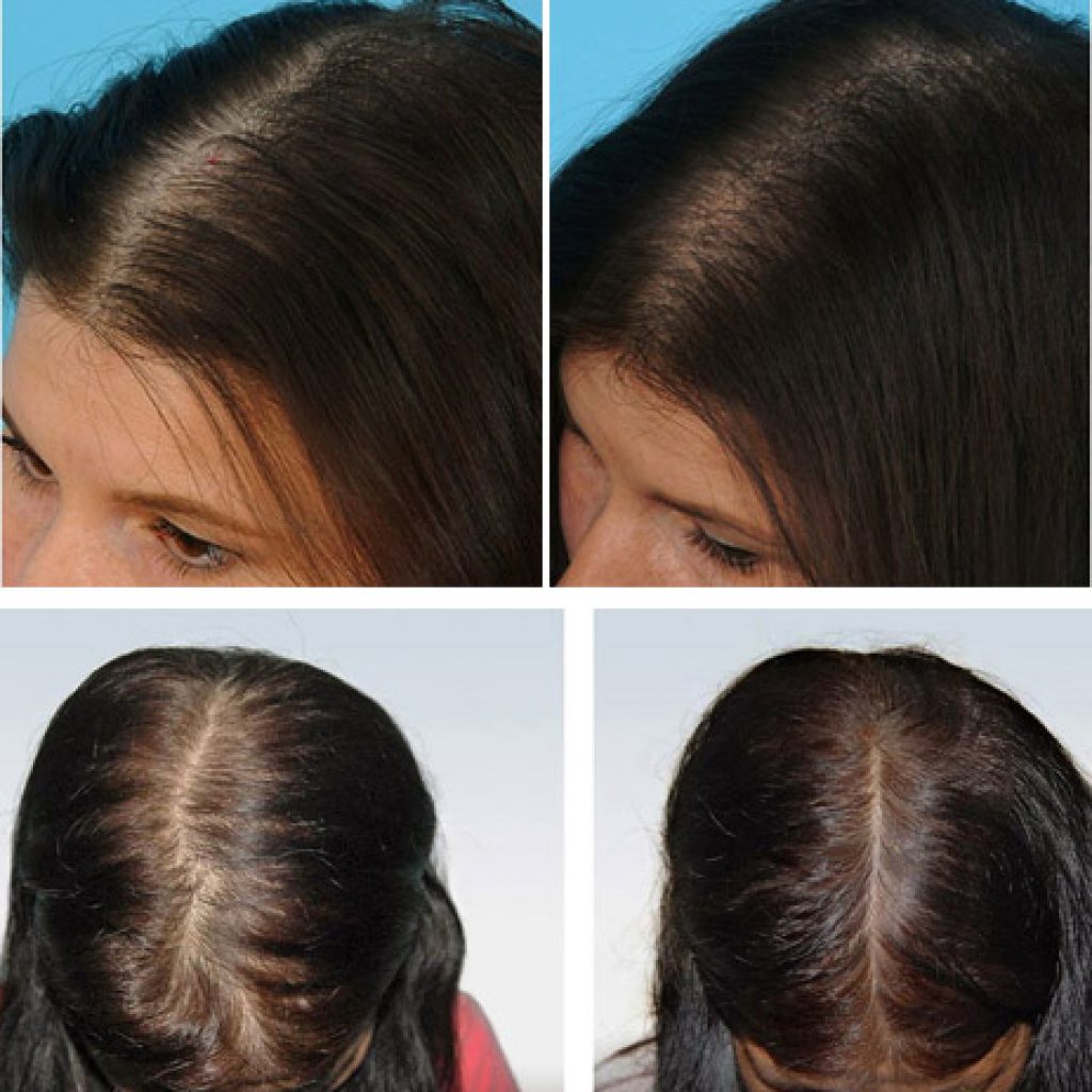 Мезотерапия для волос москва. Мезотерапия для волос. Мезотерапия волос до и после. Плазмолифтинг для волос. Мезотерапия волос до посла.