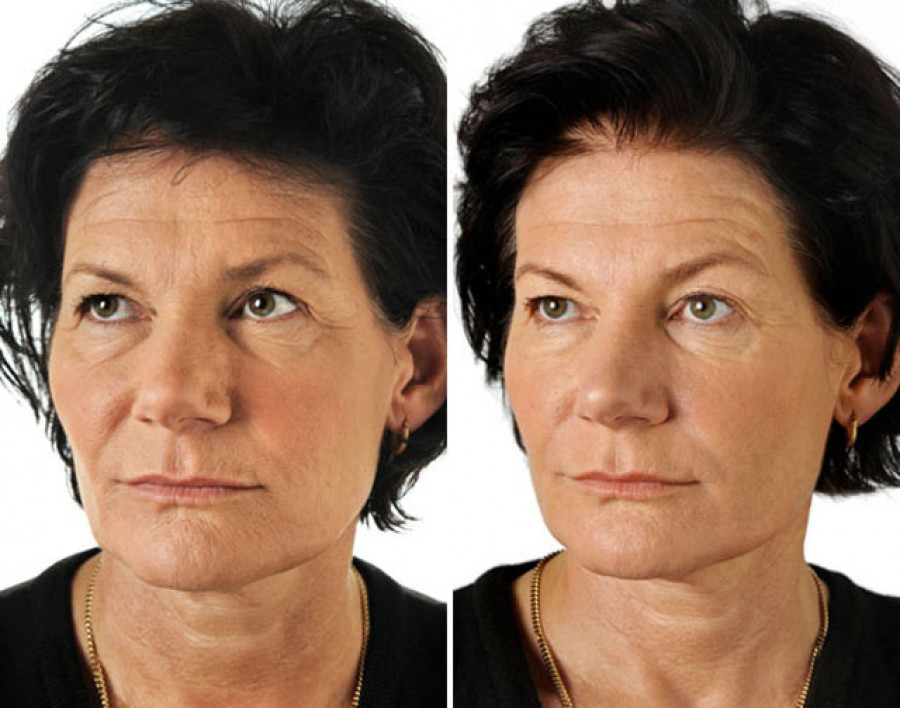 Лица отзывы. Биоревитализация лица до и после. Ревитализация лица до и после. Биоревитализация лица фото до и после.